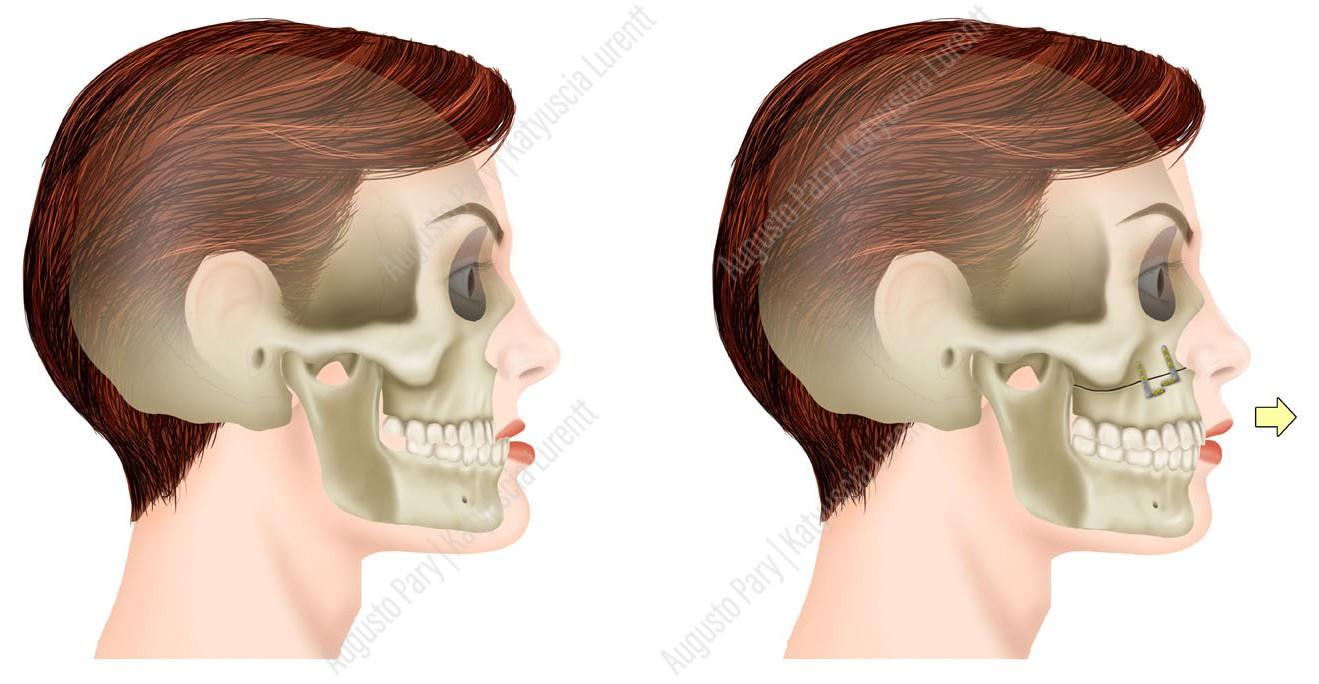 ferpa on X: prognatismo mandibular (maxilar inferior proeminente