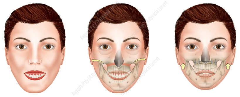 RECUO MAXILO-MANDIBULAR - CLINICA DA FACE