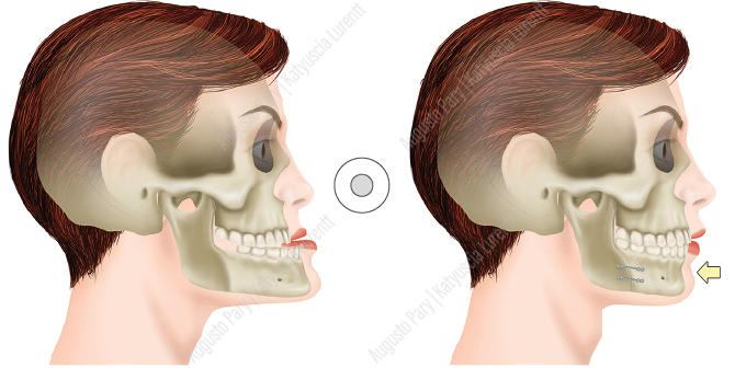 Avanco de maxila e recuo de mandibula - Ortognatica - Dr Felipe